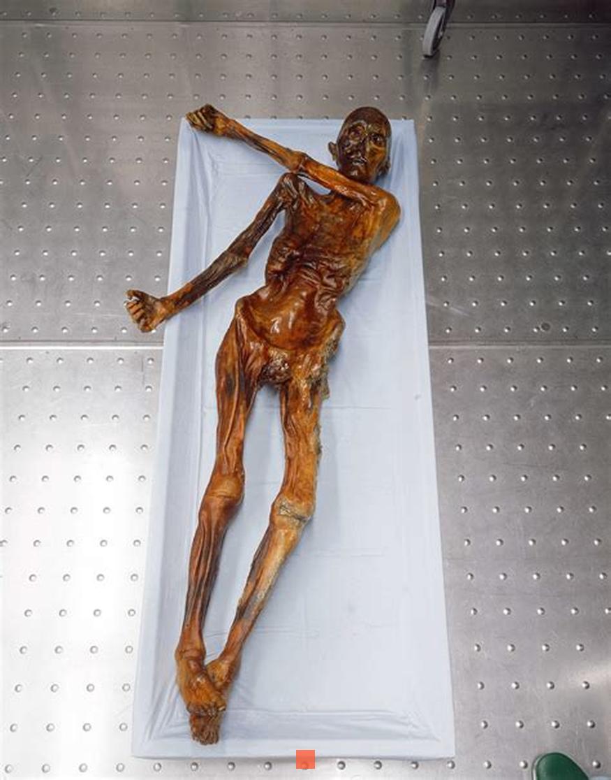 Autre découverte remarquable, l’estomac d’Ötzi était porteur d’Helicobacter pylori, bactérie présente aujourd’hui chez la moitié de la population mondiale, qui peut avoir des effets mortels chez 10 % d’entre nous. De nos jours, la souche dominante de H. pylori en Europe est en fait un hybride de souches asiatique et africaine. La souche présente chez Ötzi est presque uniquement asiatique, ce qui tend à montrer que la souche africaine est arrivée en Europe après sa mort. Cela apporte des éléments de réponse à la question de savoir si H. pylori fait naturellement partie de notre microbiote intestinal ou s’il faut traiter la bactérie avec un antibiotique dès qu’on l’identifie.