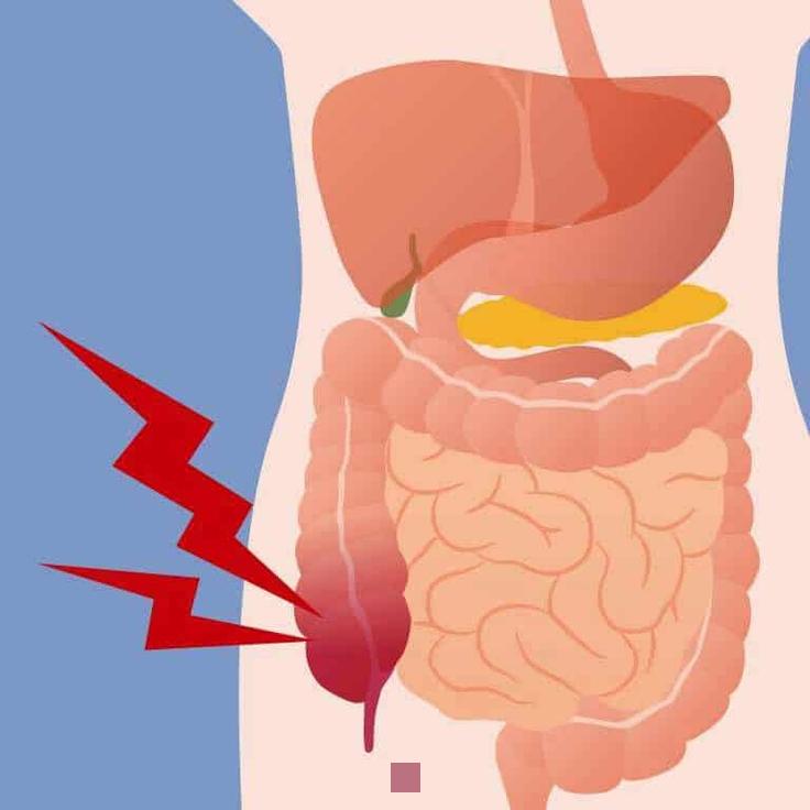 Comment diagnostiquer l'appendicite : Tests et symptômes à connaître