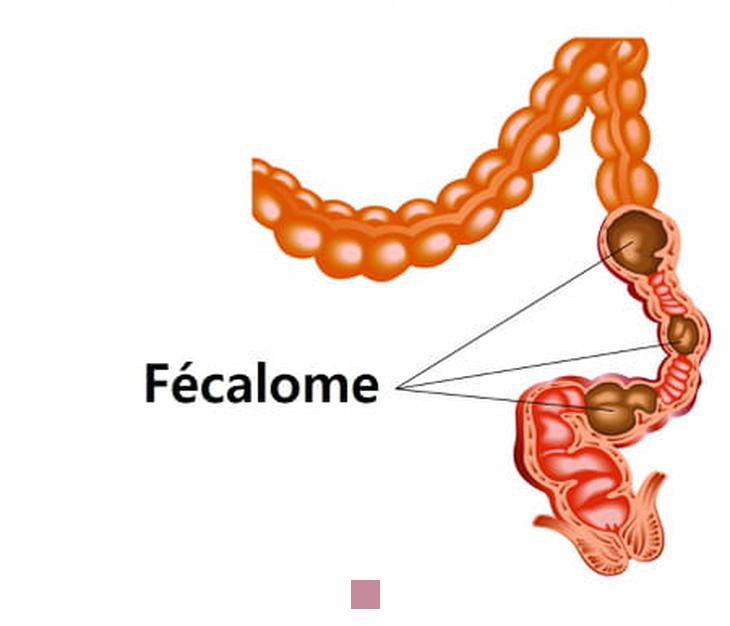 Constipation sévère : comprendre et soulager le fécalome