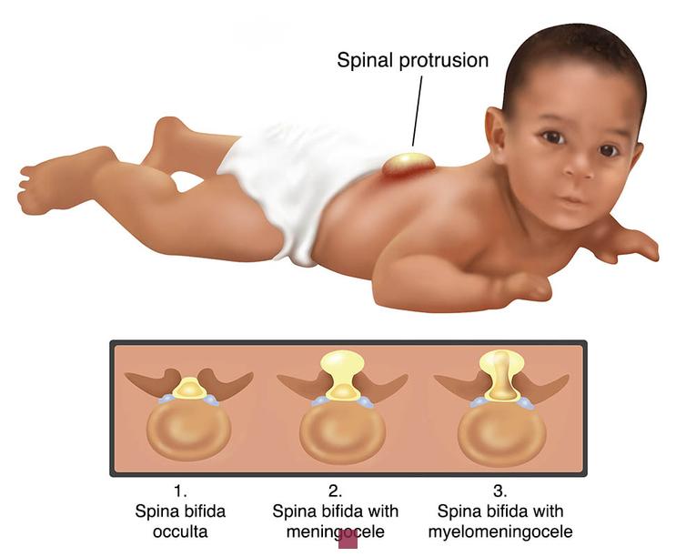 Spina bifida adulte : Défis, Soins et Perspectives